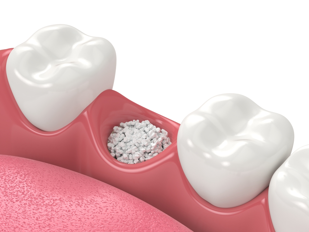 Tooth socket preservation treatment in Deer Park, TX