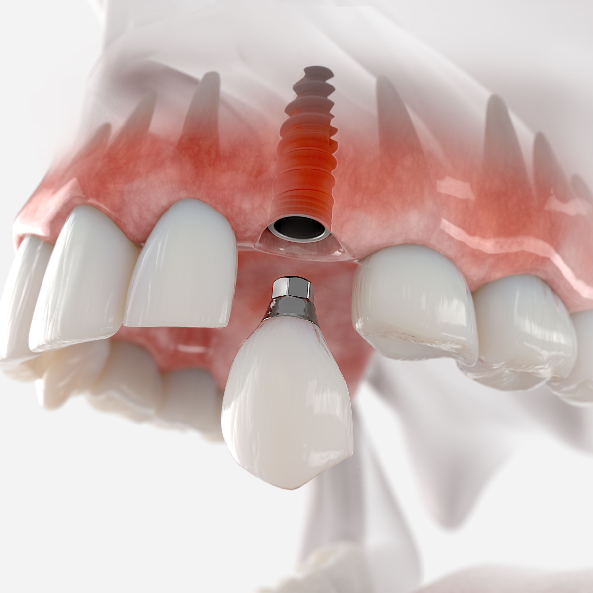 Oral implant care in Deer Park, TX