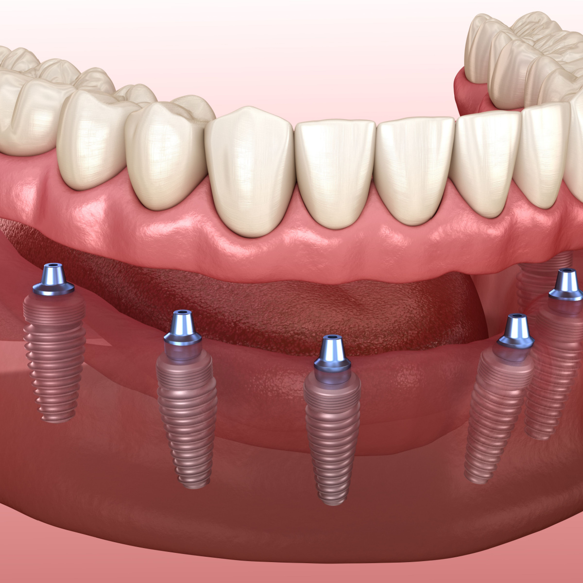 Implant supported dentures treatment in Deer Park, TX