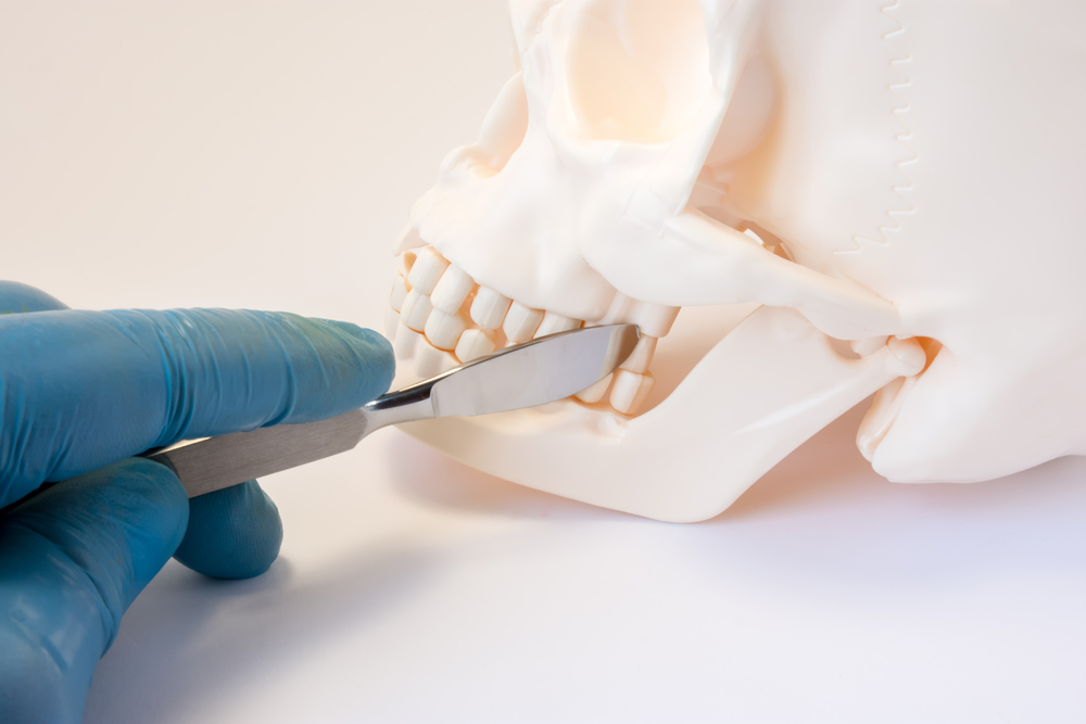 Jaw Bone graft in Deer Park, TX