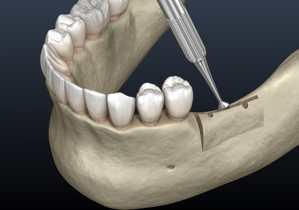 Dental bone grafting procedure in Deer Park, TX