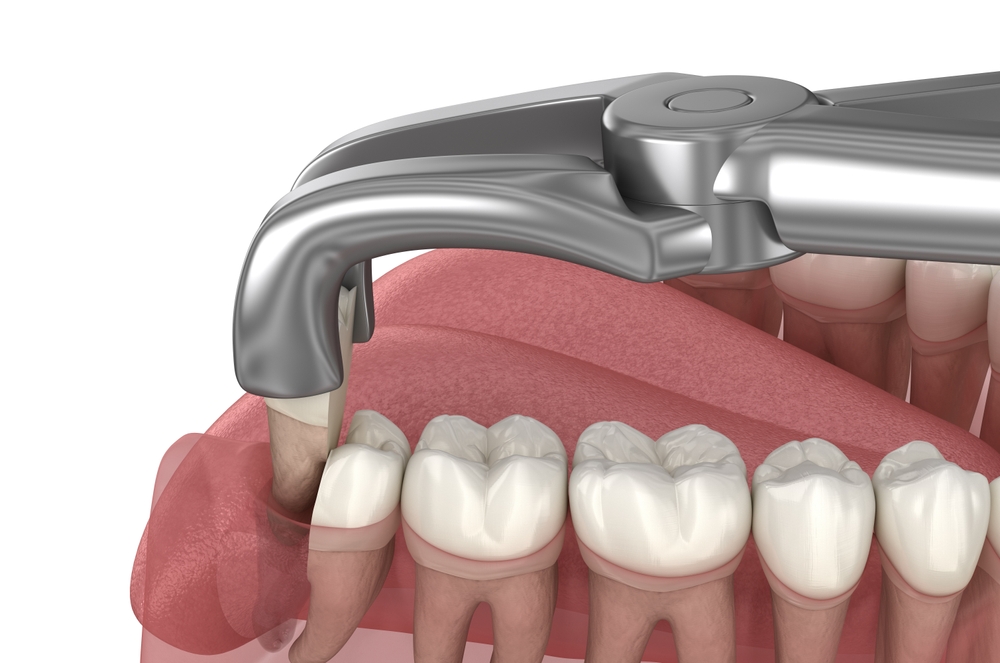 Tooth extraction procedure in Deer Park, TX