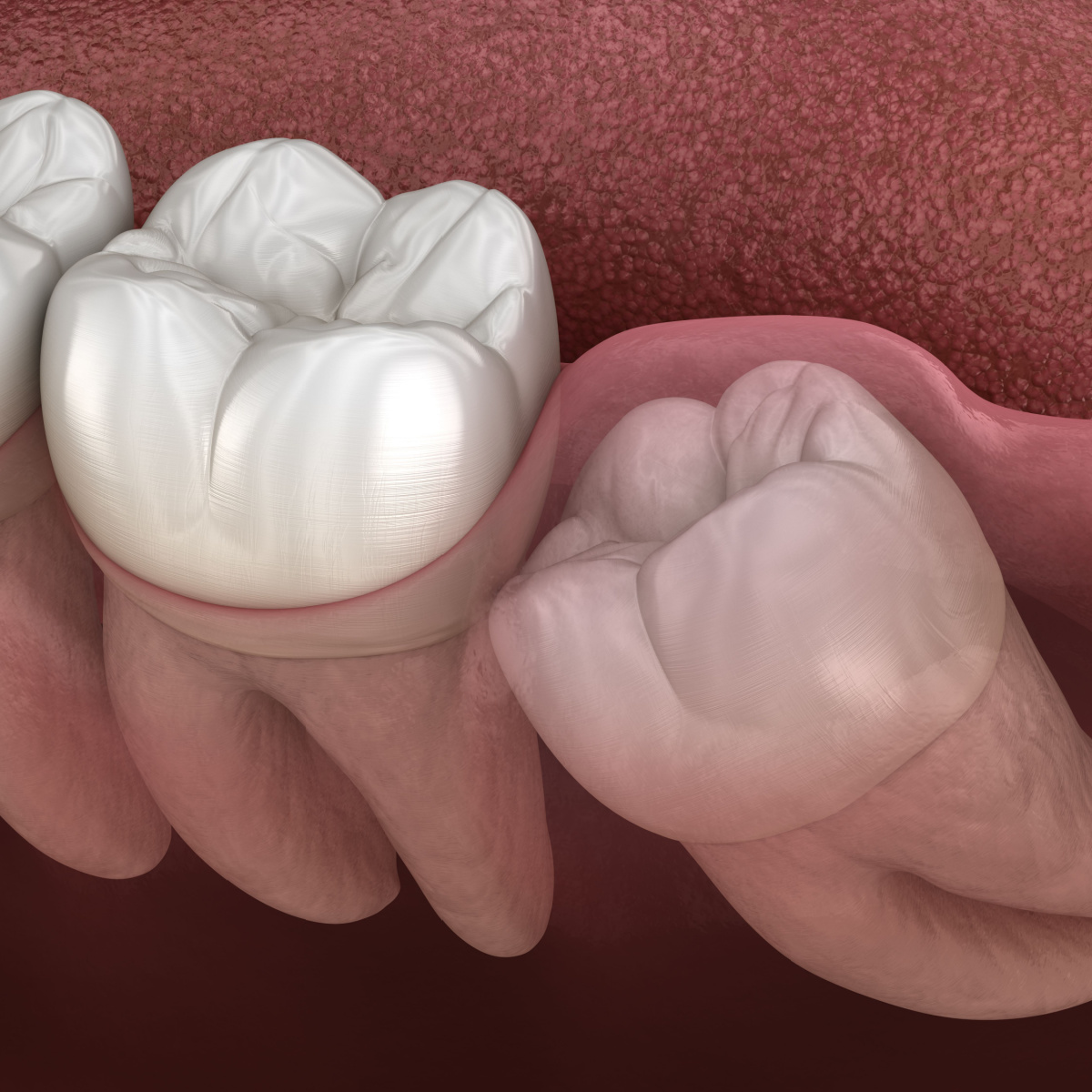 Wisdom teeth removal in Deer Park, TX