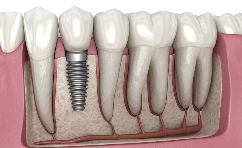 Dental implant dentist in Deer Park, TX