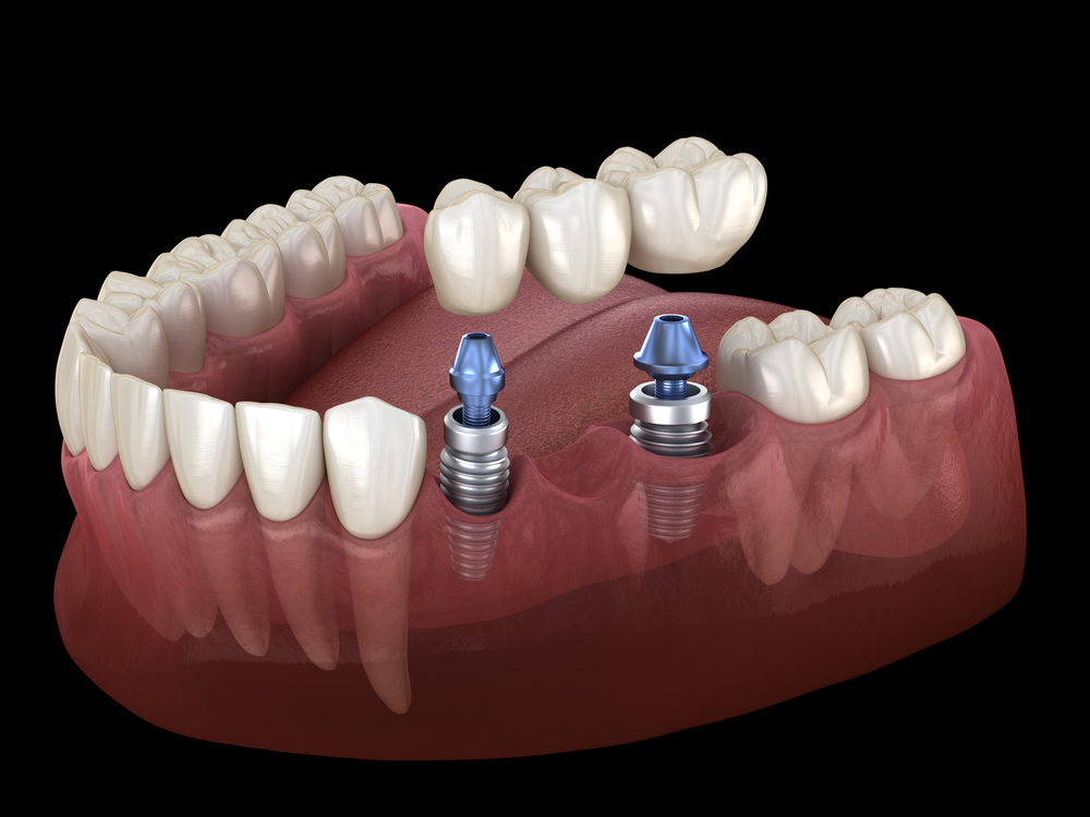 Implant dental bridges available in Deer Park, TX