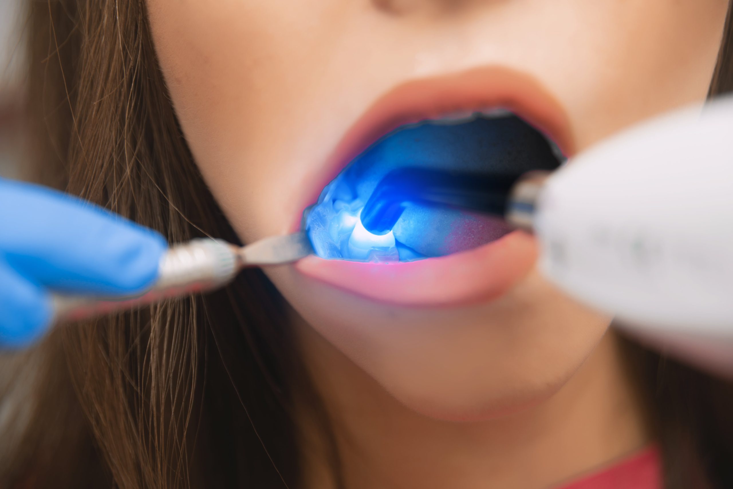 Dental cavity filling in Deer Park, TX