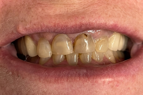 Crown_Before-6