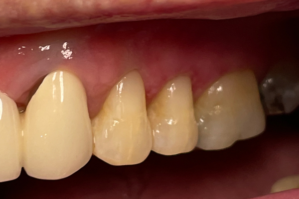 After image