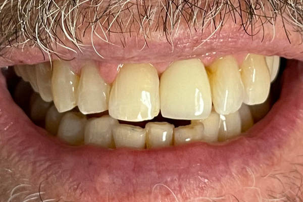 Implant_After-2