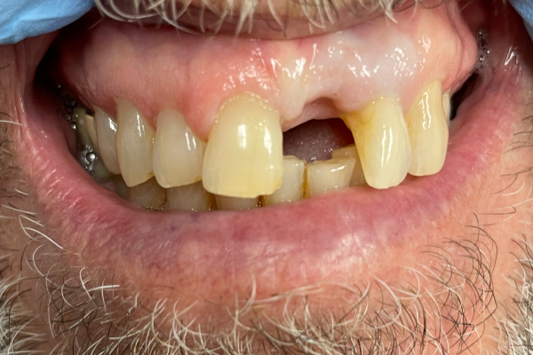 Implant_Before-1