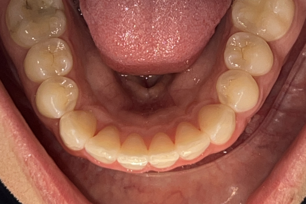 After image