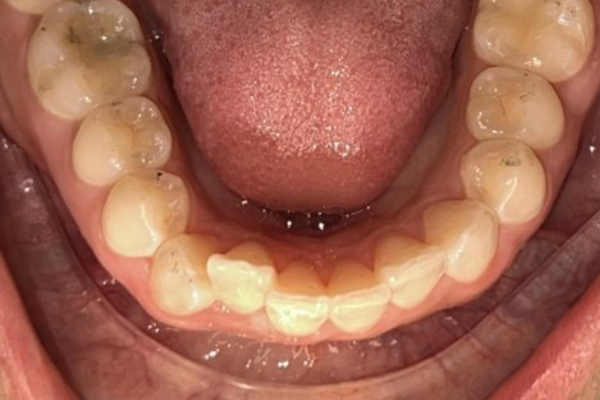 Invisalign_Before-1