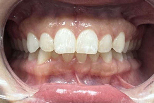 Invisalign_Before-2