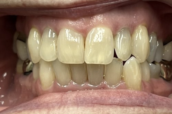Invisalign_Before-3