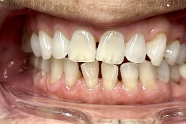 Invisalign_Before
