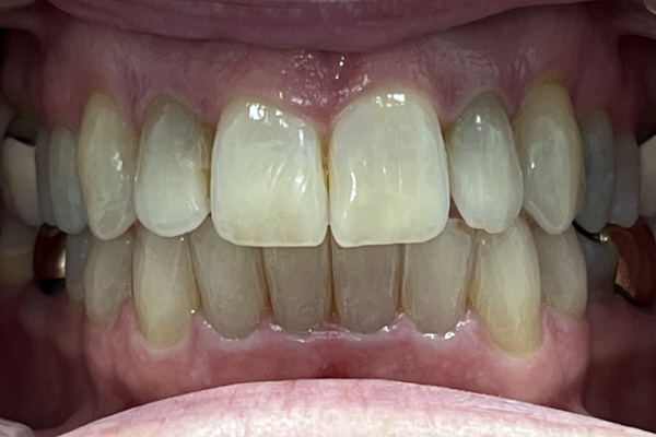 Invisalign_Post-1