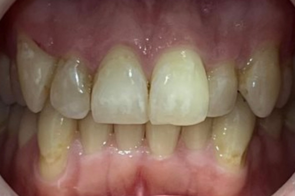 Whitening_Before