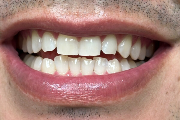 Whitening_Post-1