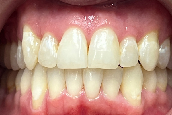Whitening_Post